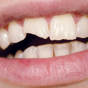 CHIPPED-TOOTH-MAYFIELD DENTAL BRAMPTON AND CLEDONE