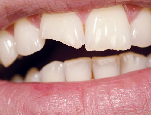 CHIPPED-TOOTH-MAYFIELD DENTAL BRAMPTON AND CLEDONE