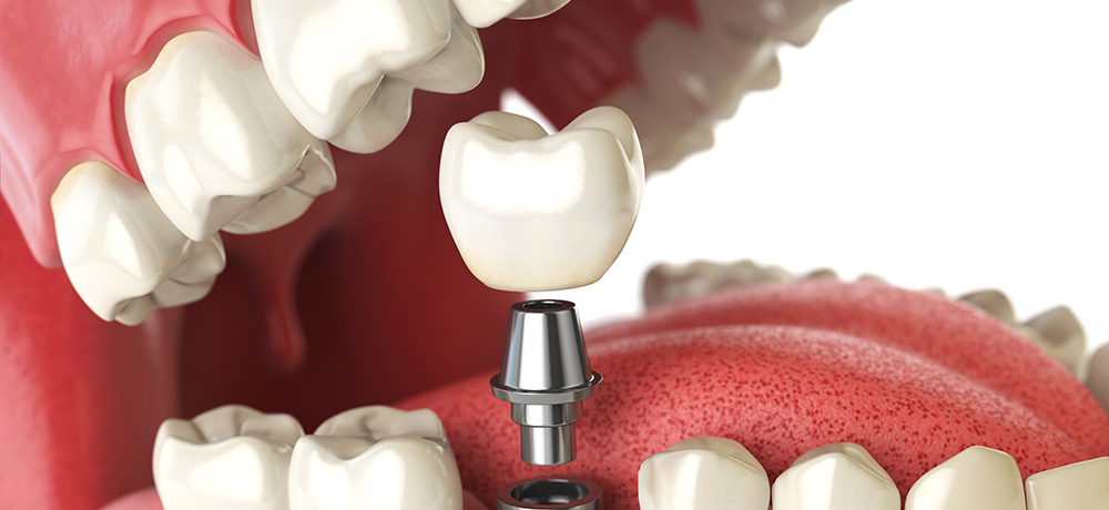 DENTAL IMPLANTS TREATMENT