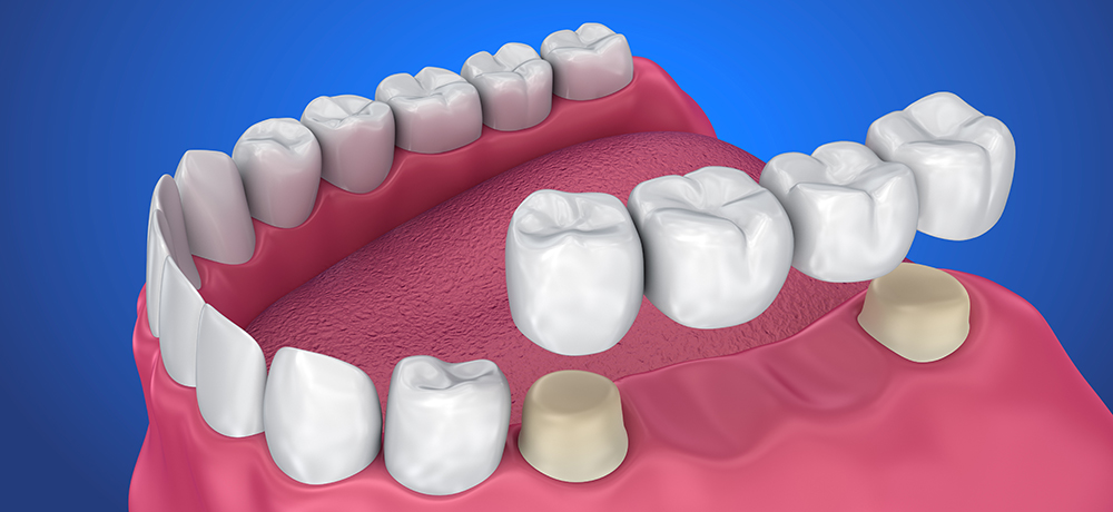 Dental Crowns and Bridges