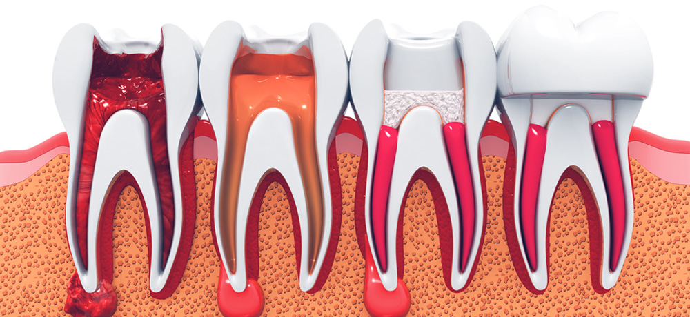 ROOT CANAL TREATMENT