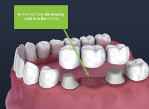What Are Dental Crowns And Dental Bridges?