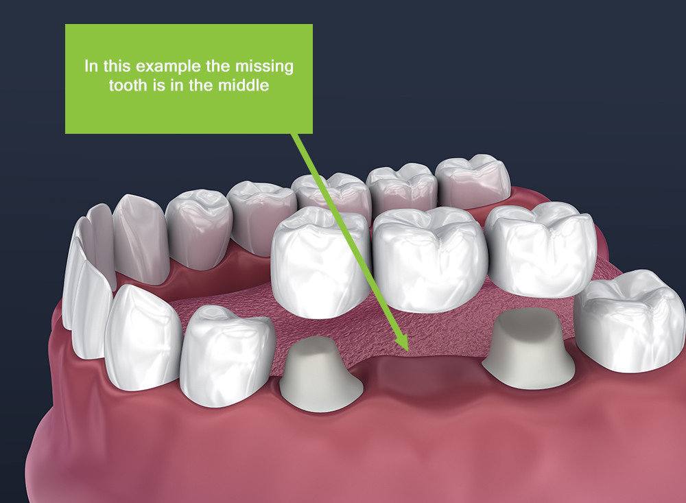 the anchoring of a crown bridge or denture