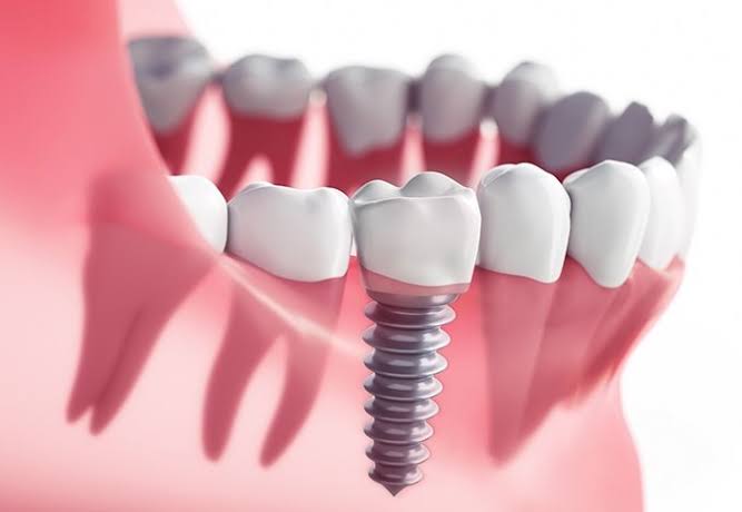 Replacing Missing Teeth In Brampton: What You Need To Know About Dental Implant Procedure