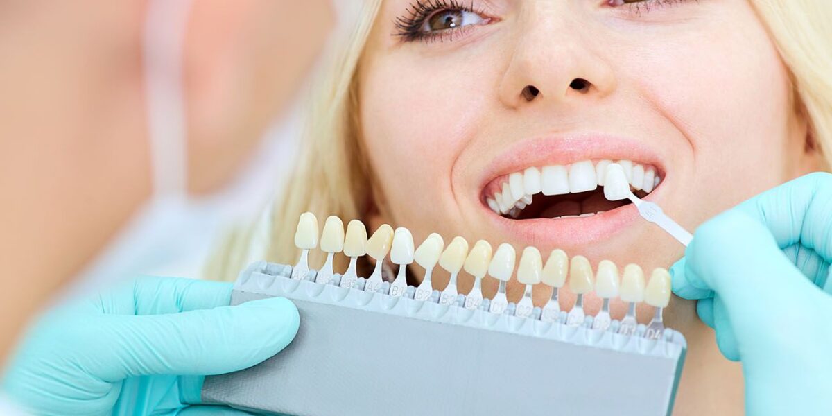 10 Things You Need To Know Before Getting Dental Veneers In Brampton