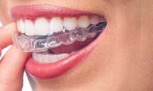 Does Invisalign Hurt? What Are The Benefits