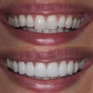 Cosmetic Tooth Reshaping And Dental Contouring To Improve Your Smile In Brampton