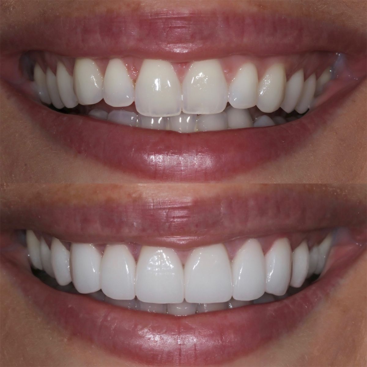 Shaping your smile: the pros and cons of tooth contouring