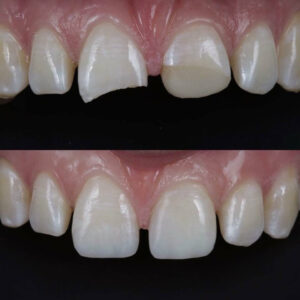 Cosmetic Tooth Reshaping And Dental Contouring