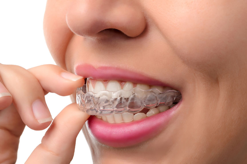 9 Tips to Get the Most from Your Invisalign Braces