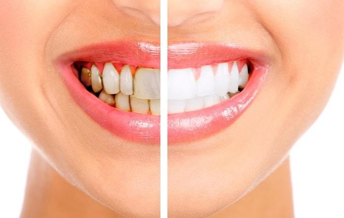 Affordable Dental Cleaning And Teeth Whitening Treatment In Brampton