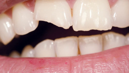 Chipped or Broken Teeths