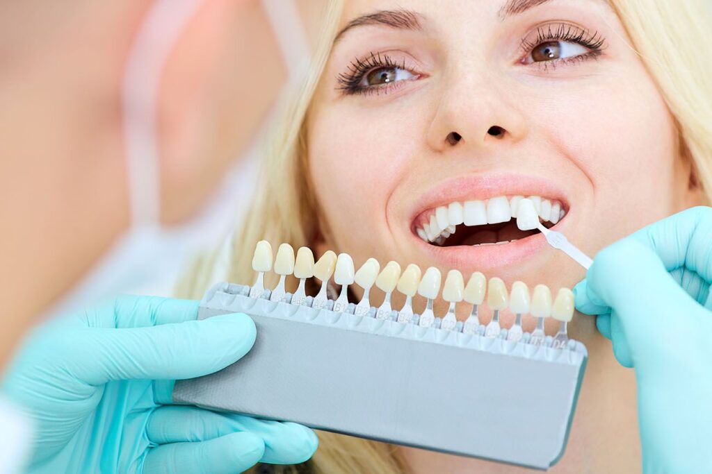 DENTAL-VENEERS