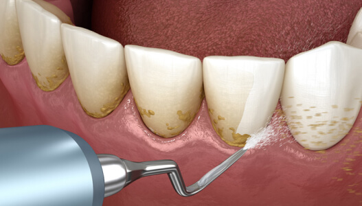 Individuals-with-Gum Disease or Other Conditions