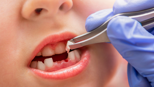 Preparing for Your Tooth Extraction