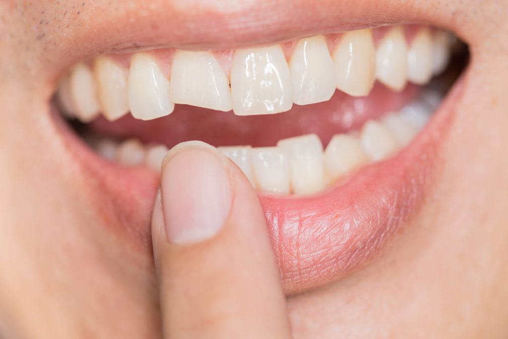 chipped-tooth-mayfield-dental-brampton-and-cledon-1