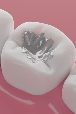 Amalgam Fillings