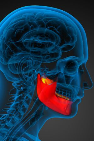 Bone loss in the jaw