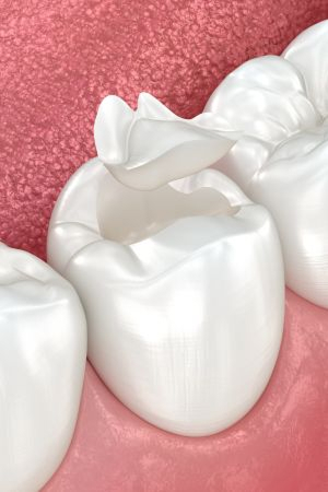 Ceramic Fillings