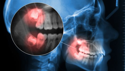 Complex Tooth Structure