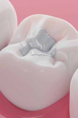 Composite Fillings