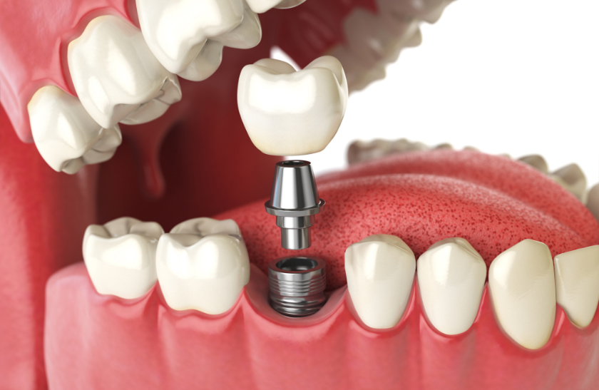 Dental Implants