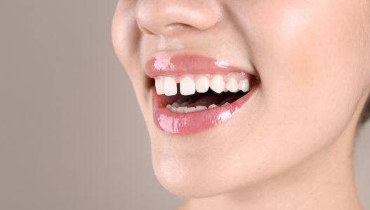 Gaps between teeth