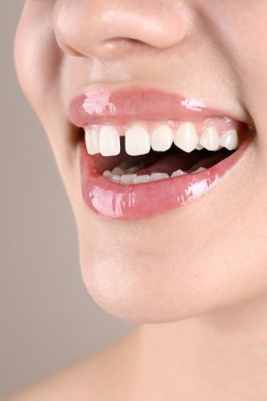 Gaps between teeth