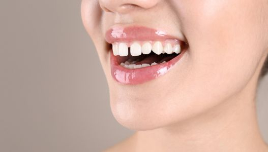 Gaps between teeth