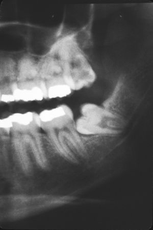 Impacted Wisdom Teeth