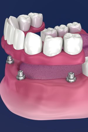 Implant Supported Bridges