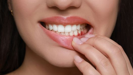 Long Term Gum Health