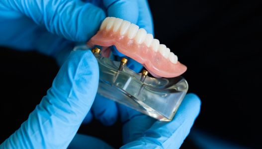 Partial Dentures