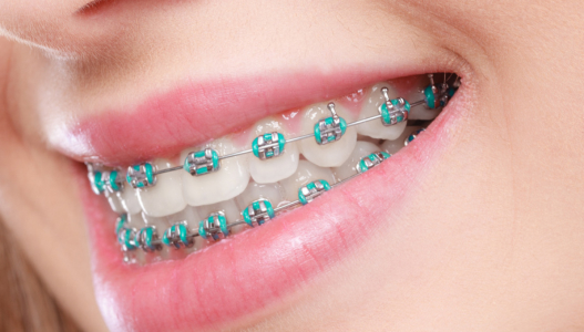 Placement of Braces