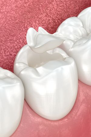 Porcelain Crowns