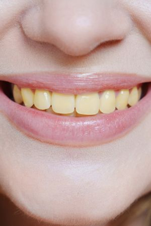 Yellow or stained teeth