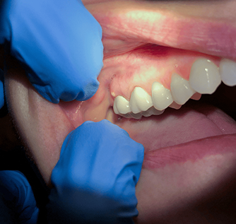 Managing Severe Toothache or Abscess 1