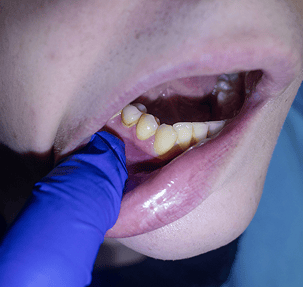 Plaque and Tartar Removal_ The Foundation of Dental Hygiene