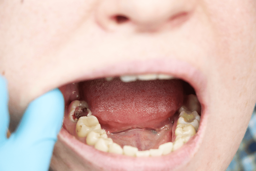 Visible Holes or Dark Spots on Teeth