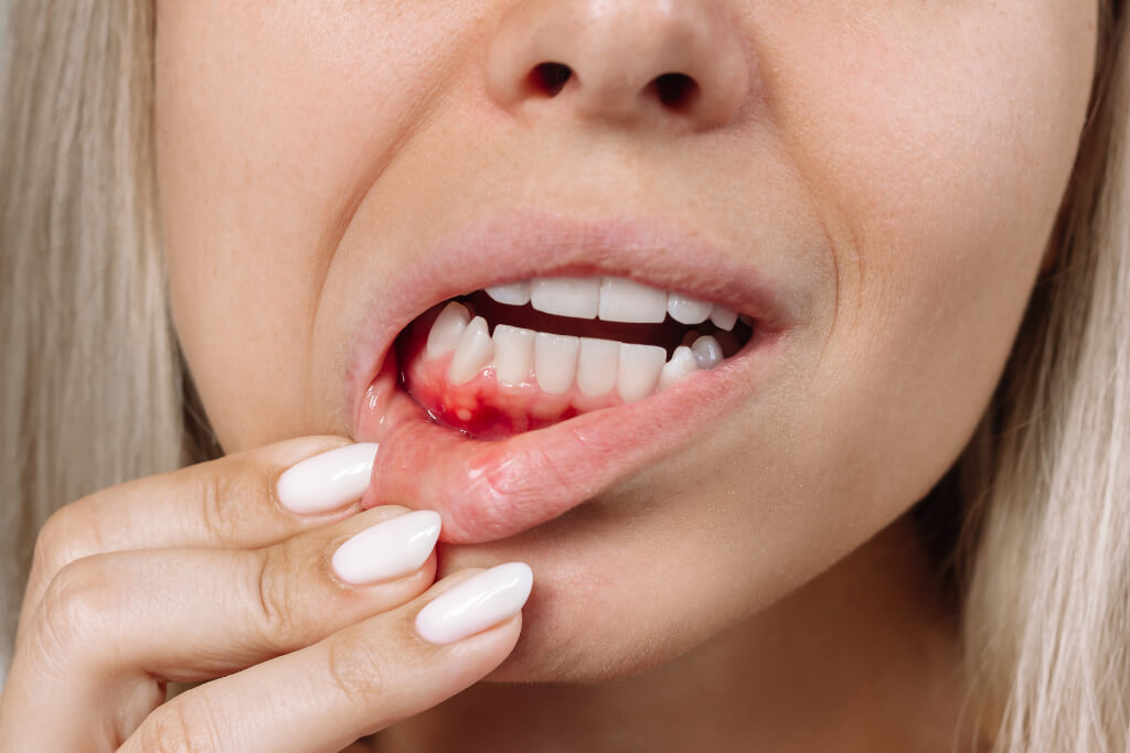 Bleeding Gums During Brushing or Flossing
