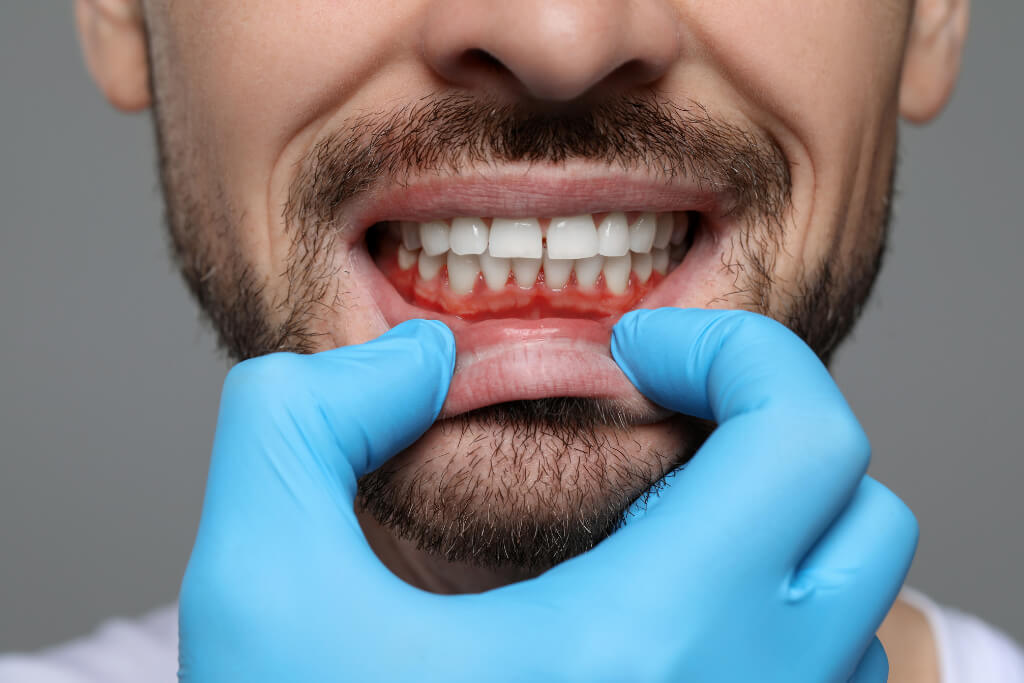 Gum Disease Symptoms You Should Never Ignore