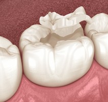 How Ice Affects Tooth Enamel