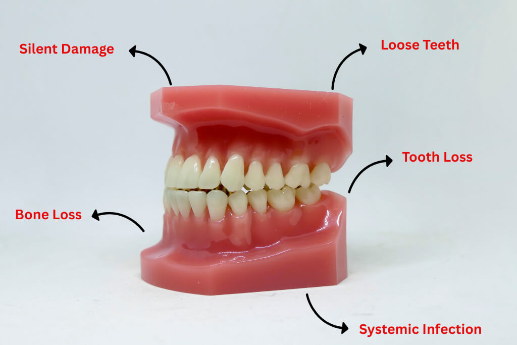 How Untreated Gum Disease Progresses