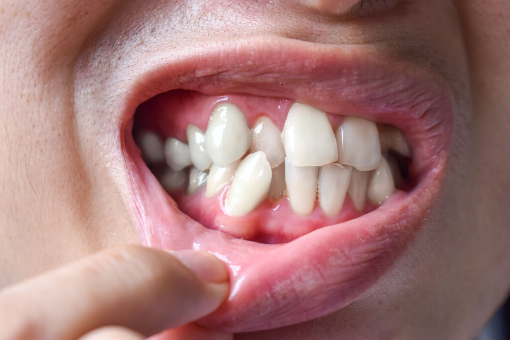 Loose or Shifting Teeth