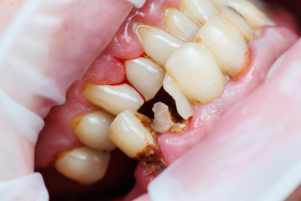 Receding Gums or Teeth Appearing Longer