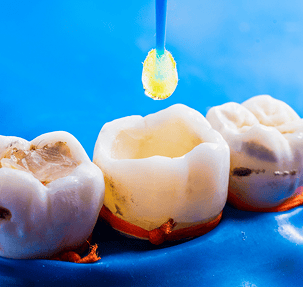 Risks of Cracking, Chipping, or Damaging Fillings