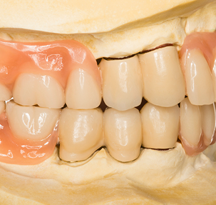 What to Do if Your Dentures Break or Stop Fitting