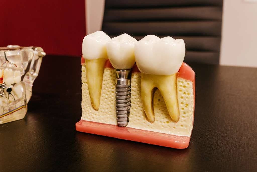 How Long Does It Take Dental Implants to Heal