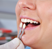 Essential Benefits of Porcelain Veneers: Are They Good for Your Teeth?