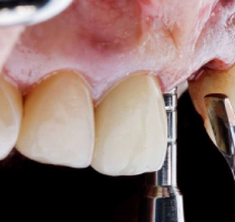 Role of Bone Grafting in the Healing Process